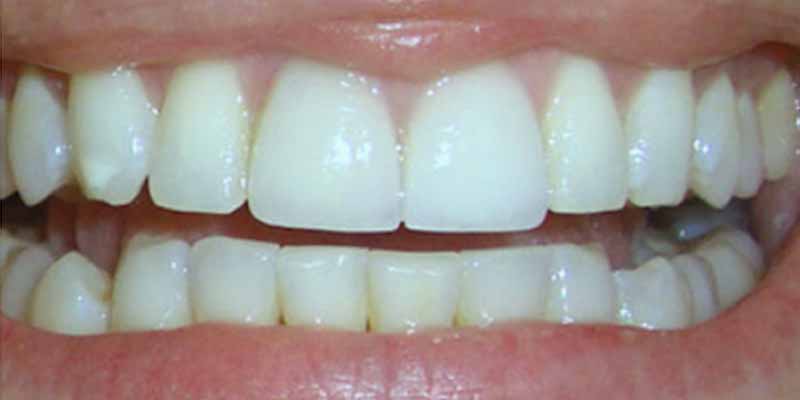 Teeth whitening before and after results with Smile Science