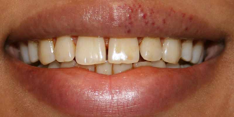 Stained teeth before whitening treatment